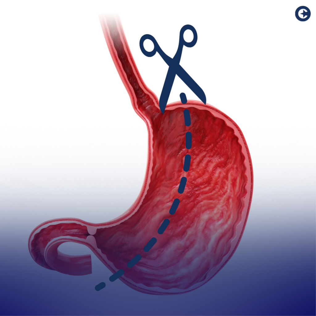 Bariatric Surgery and Insurance Coverage Understanding the Complex