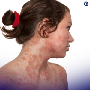 Celebrate National Eczema Week by deepening your understanding of eczema. Learn about its management, how health insurance can help, and why awareness matters.

