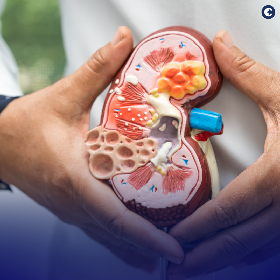 Discover how Chronic Kidney Disease (CKD) impacts the workforce and how employers can integrate CKD-focused strategies to support affected employees, boost productivity, and reduce healthcare costs.