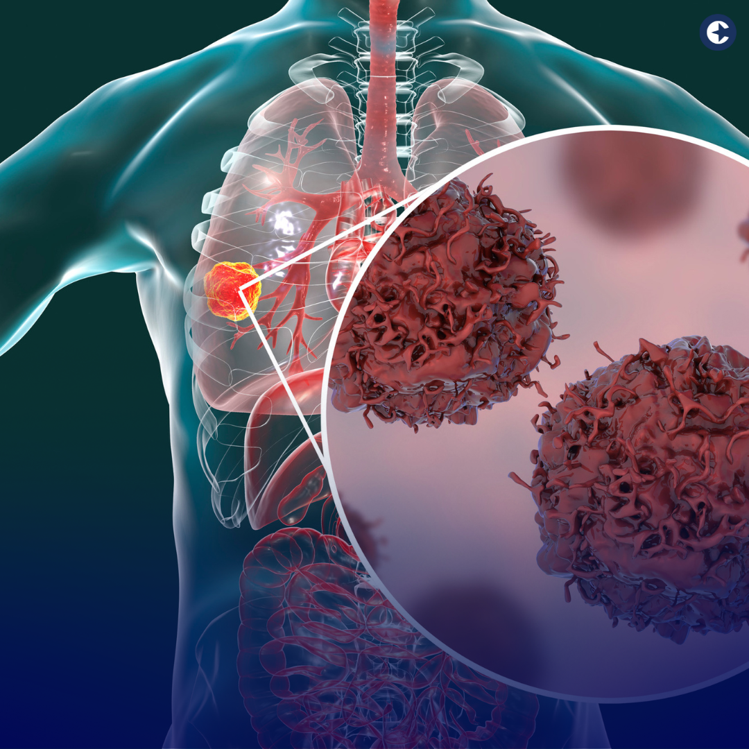 Raise awareness during Lung Cancer Awareness Month with our blog. Discover key facts, risk factors, and ways to support the fight against this deadly disease.