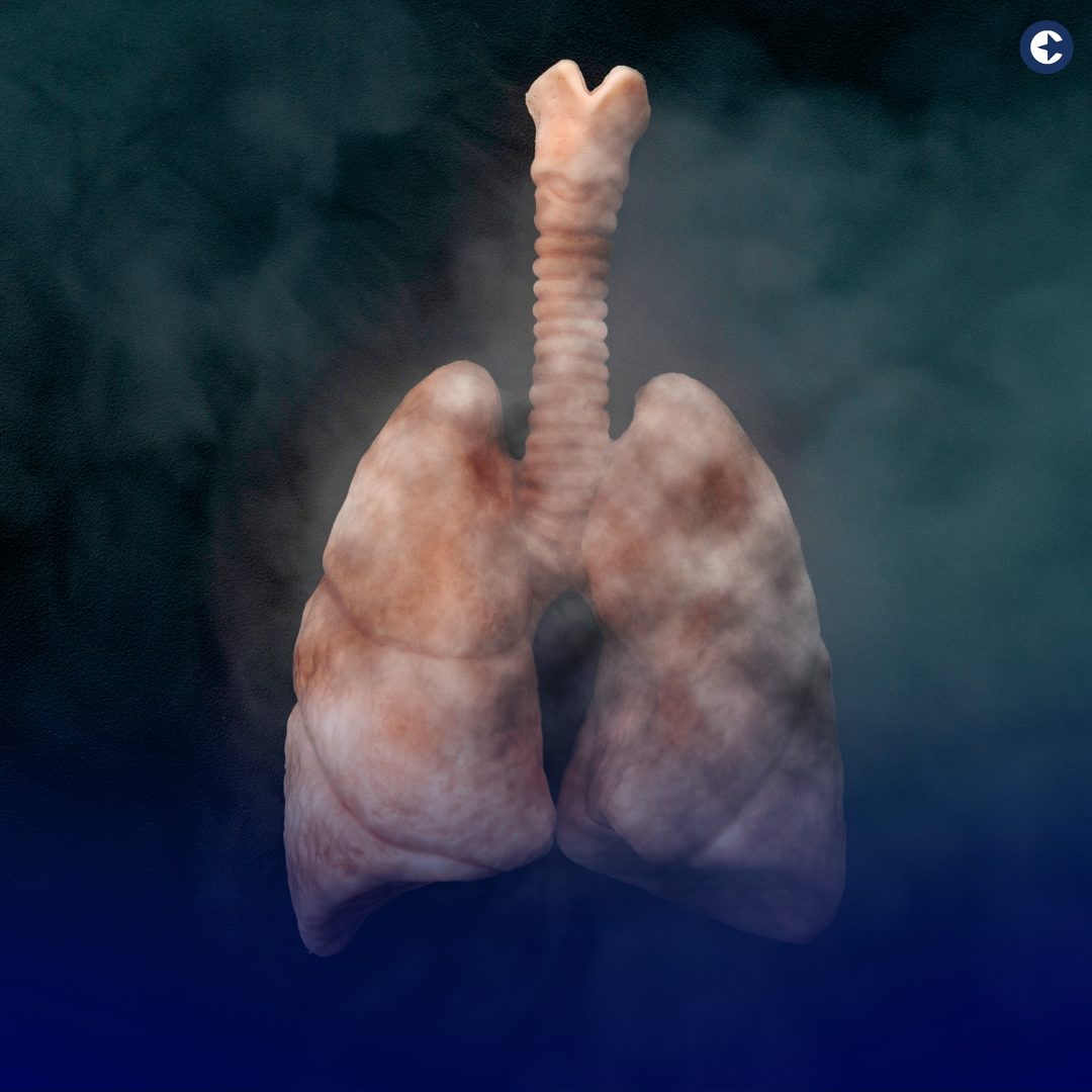 Explore the updated lung cancer screening guidelines by the ACS, their implications for millions of Americans, and the critical role of employers in promoting early detection and saving lives.