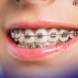 Unravel how dental insurance covers braces, from understanding eligibility and limitations to navigating claims and maximizing your coverage.